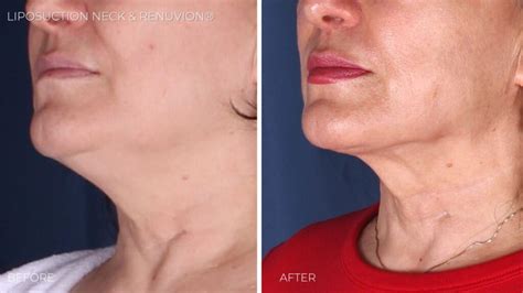 Neck Lift Alternatives: Surgical & Non-surgical Options | Omaha ...