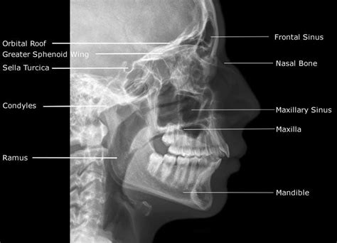 RxDentistry: Radiographic Anatomy of Facial Bones