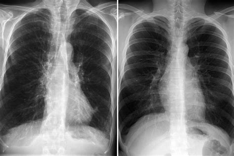 Emphysema Lung Vs Normal Lung