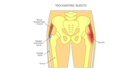 Hip Flexor Pain Causes