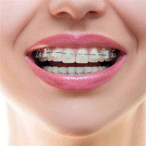 Best invisible braces - leomuscle