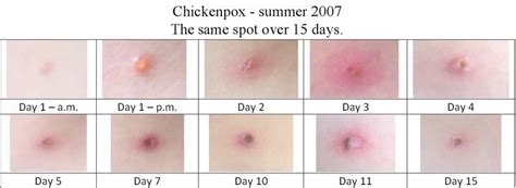 Hives vs chicken pox | BabyCenter