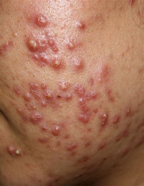 Learn about Acne Vulgaris - K B Lim Skin Clinic Pte Ltd - Dr Lim Kah Beng