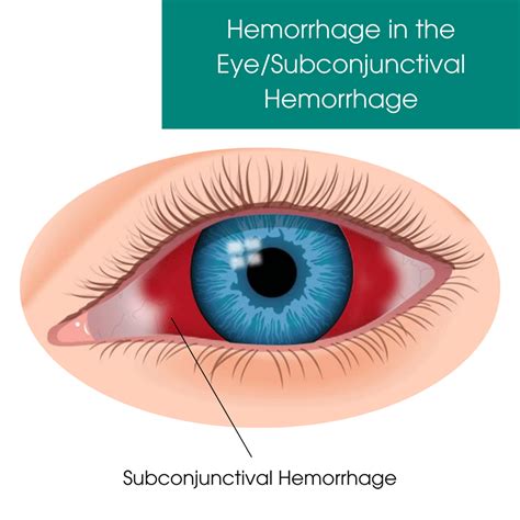 Treatment Subconjunctival Hemorrhage NYC | Eye Hemorrhage Treatment New ...