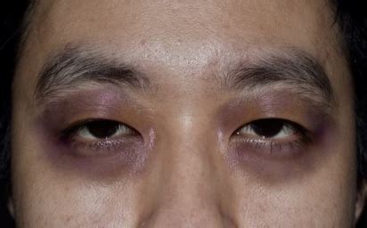 Raccoon Eyes: Causes, Prevention, and Treatment Options