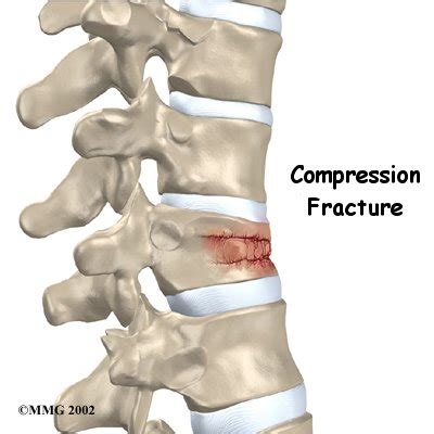 What You Need to Know About Osteoporosis | 🩺Singapore Sports ...