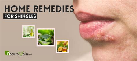 9 Effective and Best Home Remedies for Shingles