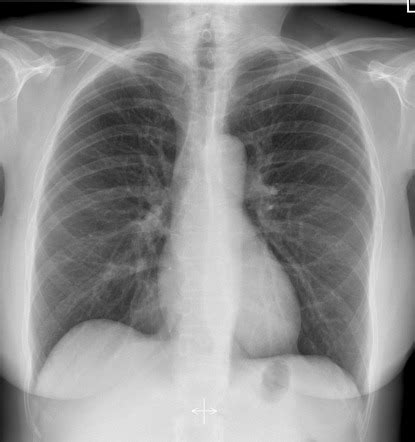 Formidable How To Check Chest X Ray Report Write Pdf A Grade 5