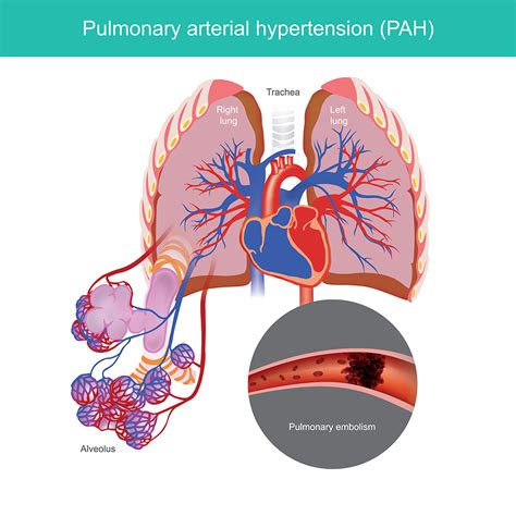 Pulmonary Artery Hypertension Symptoms