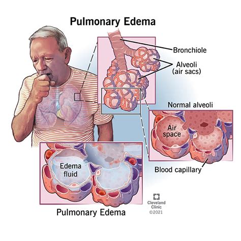 Pulmonary Edema: Causes, Symptoms, Diagnosis & Treatment