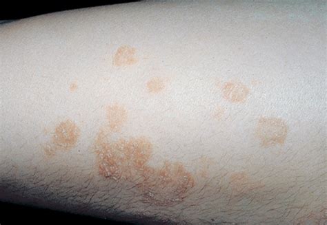 Nummular Eczema - Pictures, Symptoms, Treatment, Causes