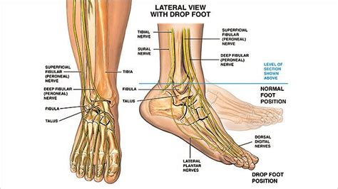 How to Keep Walking With MS Foot Drop