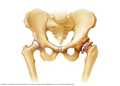 Osteoarthritis - Symptoms and causes - Mayo Clinic