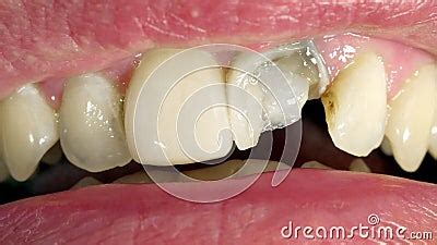 Close Up of Mouth with Broken Tooth. Man Shows Cavity for Treatment ...