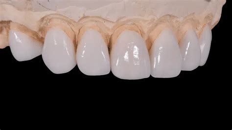 What is the Procedure for Porcelain Veneers? | Kirkland Family Dentistry