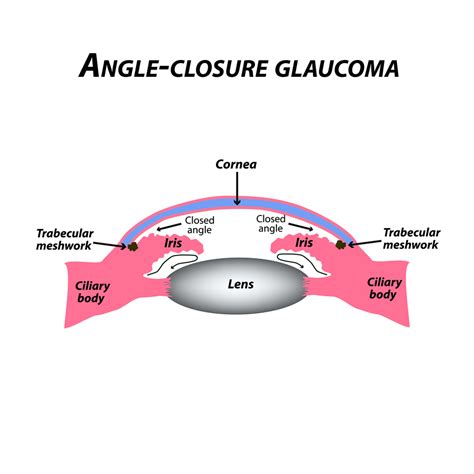 Chronic Angle-Closure Glaucoma | Eye Patient