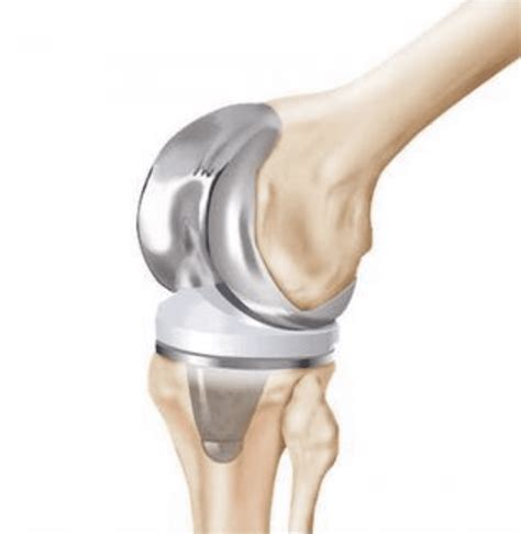 Revision Joint Replacement Surgery: Midwest Center for Joint ...