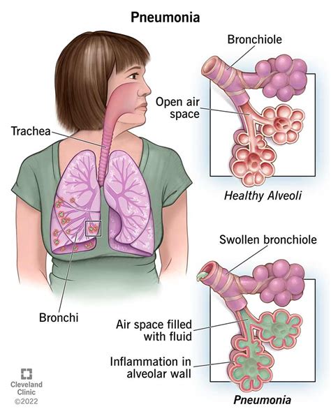 Pneumonia: Causes, Symptoms, Diagnosis & Treatment