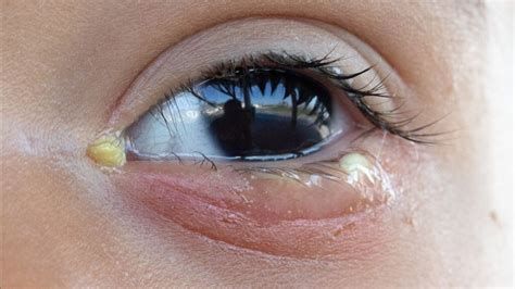 Eye Discharge: Causes, Associated Conditions, and Treatments | 1MD ...