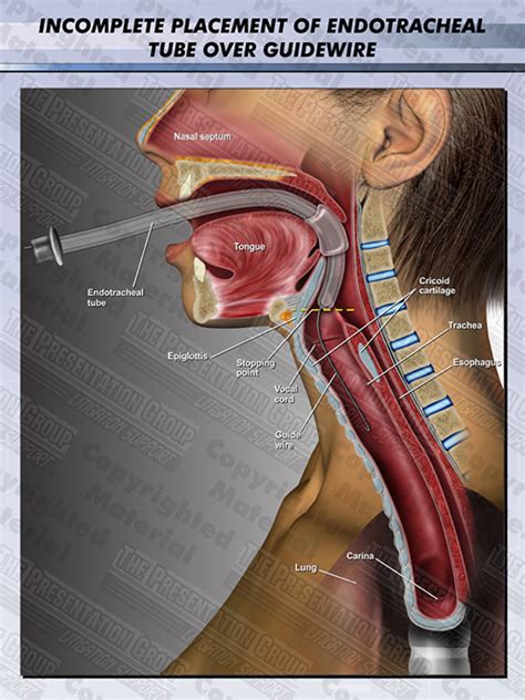 Incomplete Placement of Endotracheal Tube | Medical Legal Illustration