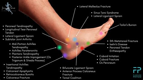 Foot Pain Chart - Find the Cause of Foot Pain with our Diagram