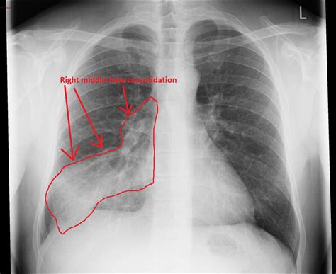 Aspiration pneumonia x-ray - wikidoc