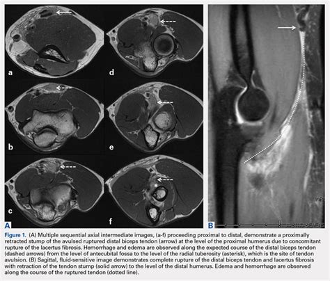 Magnetic Resonance Imaging Evaluation of the Distal Biceps Tendon ...