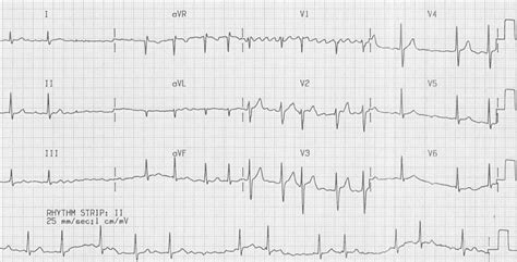 Atrial Fibrillation • LITFL • ECG Library Diagnosis