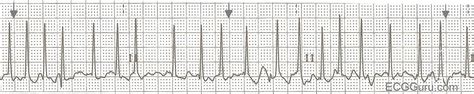 ECG Basics: Atrial Fibrillation With Rapid Ventricular Response | ECG ...