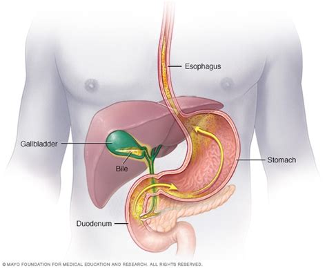 Bile reflux - Symptoms & causes - Mayo Clinic