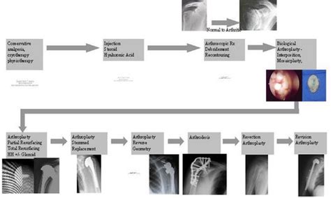 Arthritis Treatment [Shoulder] – UK Shoulder + Elbow Orthopaedic Surgery