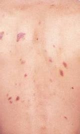 Cutaneous T-Cell Lymphoma Treatment - Favoriteplus.com Blog