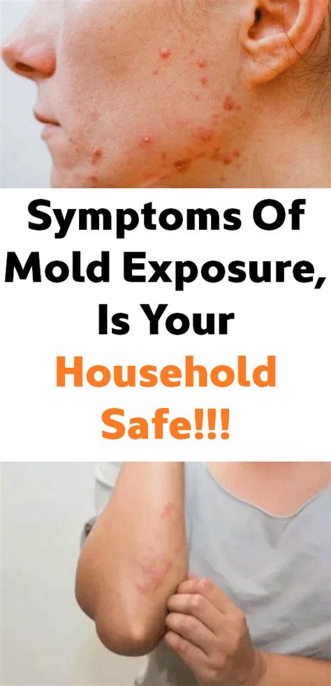 Symptoms Of Mold Exposure, Is Your Household Safe!!! | Mold exposure ...