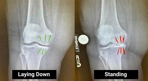 The importance of a standing knee X-ray to evaluate arthritis | Steve ...