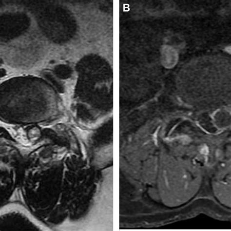 Intraoperative photo shows the thickened ligamentum flavum cyst wall ...