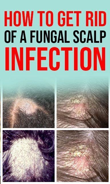 How To Get Rid Of A Fungal Scalp Infection: Causes, Symptoms, And ...