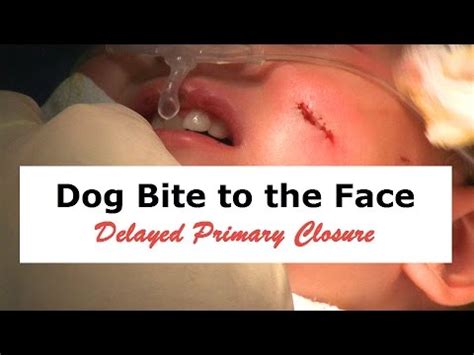 Delayed Primary Closure of Dog Bite to Face - YouTube