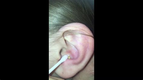 big pimple gets popped inside ear with a needle!!!! Chords - Chordify