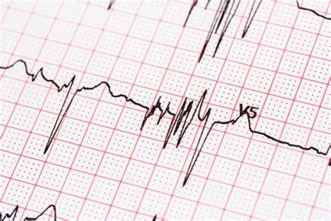 5 Things to Know About Cardioversion for Atrial Fibrillation