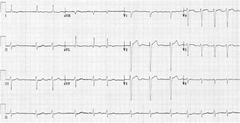 Atrial Fibrillation • LITFL • ECG Library Diagnosis