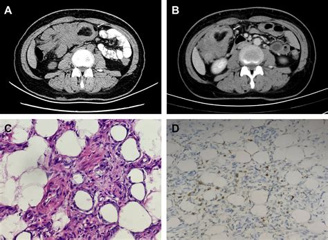 An Unusual Colonic Mass in a Young Woman - Clinical Gastroenterology ...