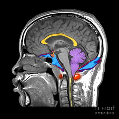 Chiari I Malformation Mri by Living Art Enterprises and Photo Researchers