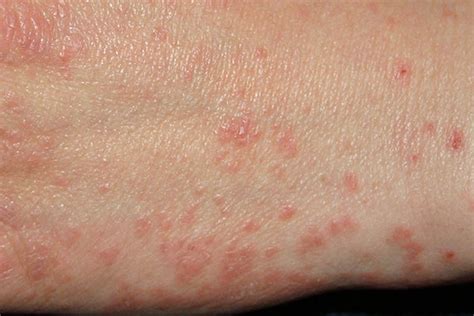 What Is Scabies?