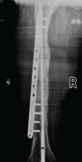 X-ray 1 year after internal fixation of the femoral shaft fracture (a ...