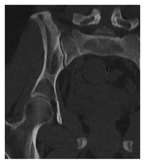 MRI T2 axial scan showed bone marrow edema at the sacrum. | Download ...