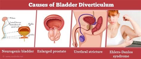 Bladder Diverticulum - Causes, Symptoms, Diagnosis and Management