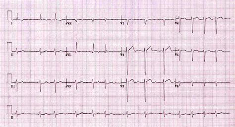 Dilt v. Metoprolol in Afib/RVR