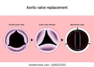 Difference Normal Aortic Valve Calcified Trileaflet: เวกเตอร์สต็อก ...