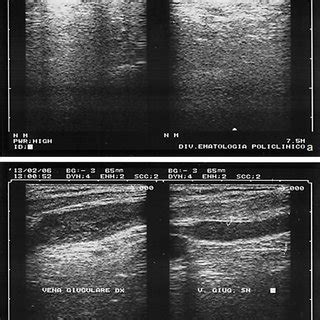 Jugular vein echography. a Right internal jugular vein thrombosis, in ...