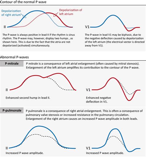 Left atrial enlargement ECG (P mitrale) & right atrial enlargement ECG ...